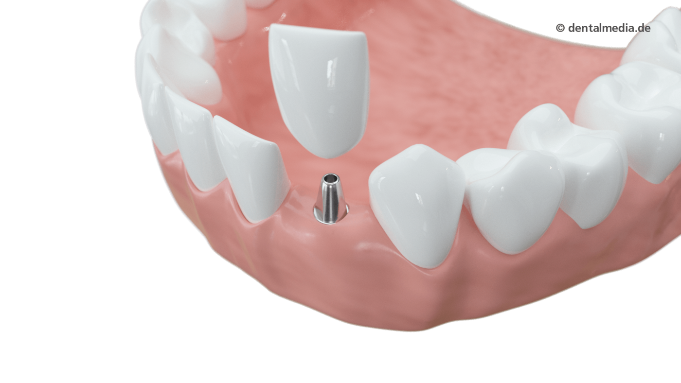 Implantologie : Ein Zahn fehlt  Ein Implantat hat gegenüber einer Brücke den Vorteil, dass Nachbarzähne nicht beschliffen werden müssen.